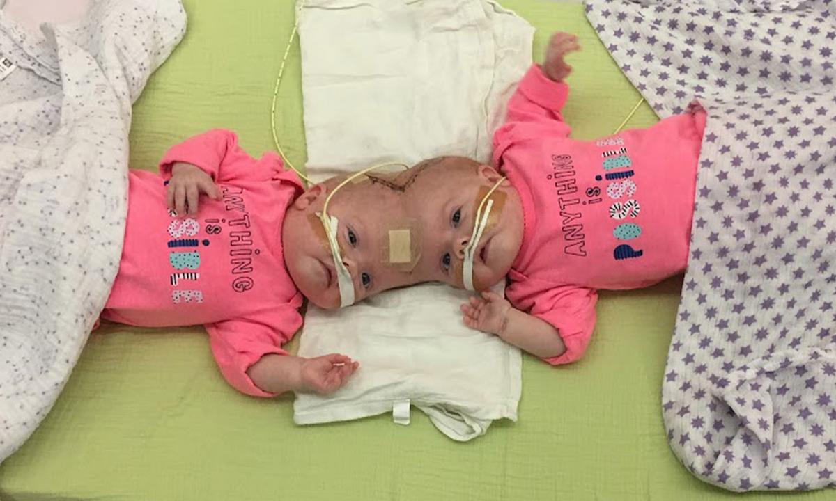 ‘One-in-2.5 Million’ Conjoined Twin Girls Who Survived Separation Surgery Graduate From Kindergarten: PHOTOS