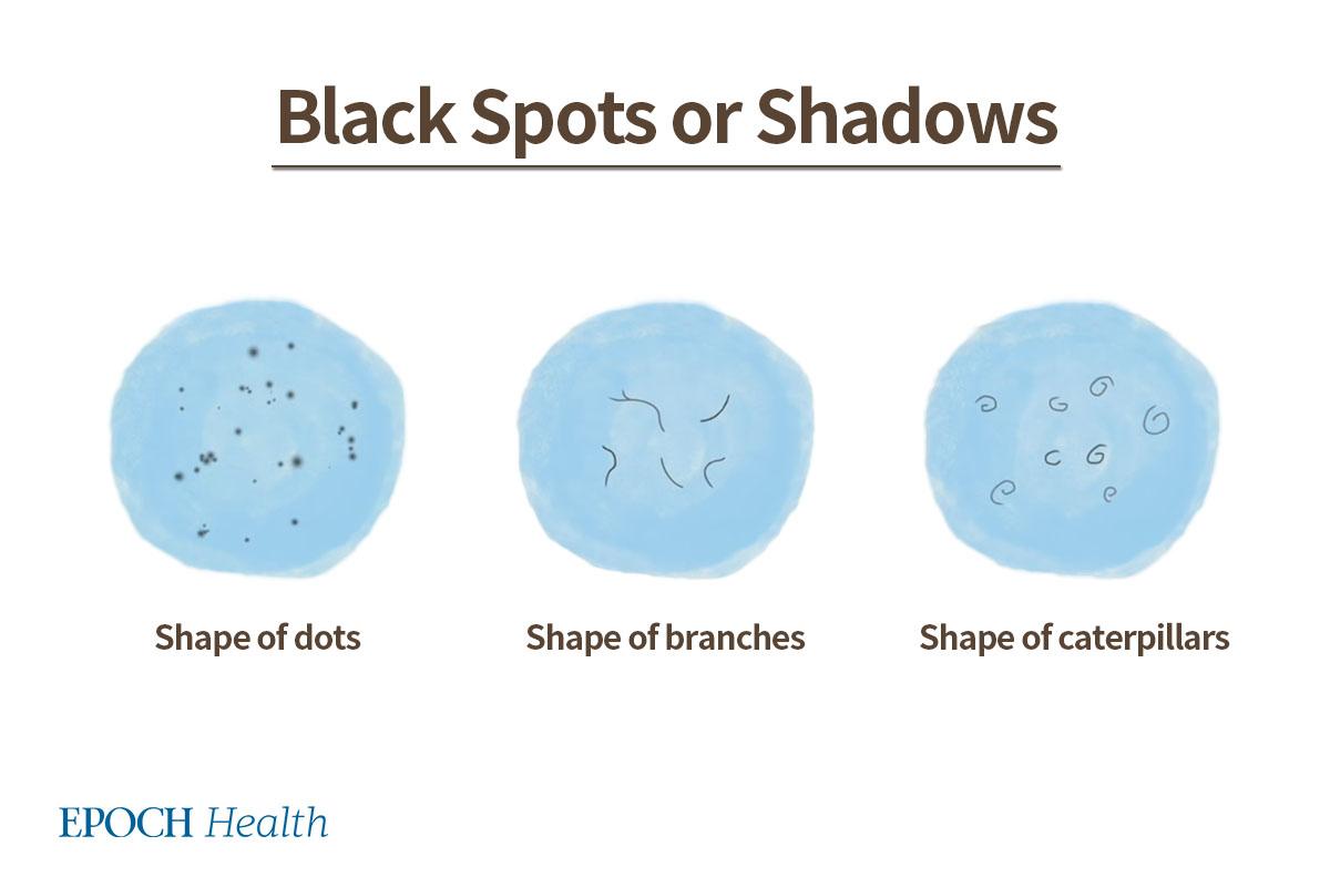 Eye floaters are black spots or shadows that appear in the shape of dots, branches, or caterpillars in front of the eyes. (The Epoch Times)