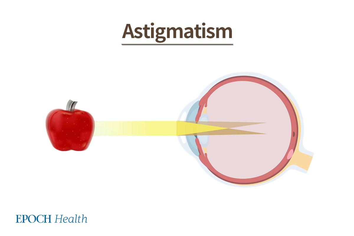 Astigmatism is caused by irregular shapes of the cornea or lens, which causes light to be refracted unevenly. (The Epoch Times)
