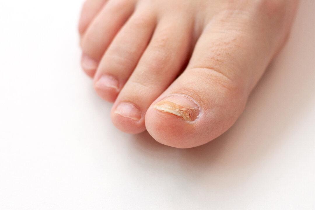 Cracked and Brittle Toenails? Fight Back Against Fungal Nail Infections With These Tips