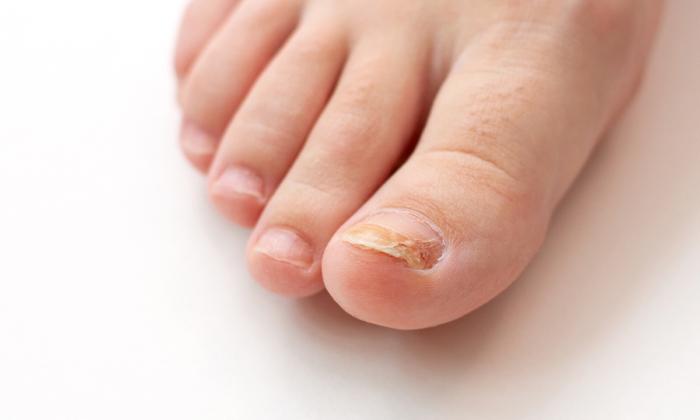 Cracked and Brittle Toenails? Fight Back Against Fungal Nail Infections With These Tips