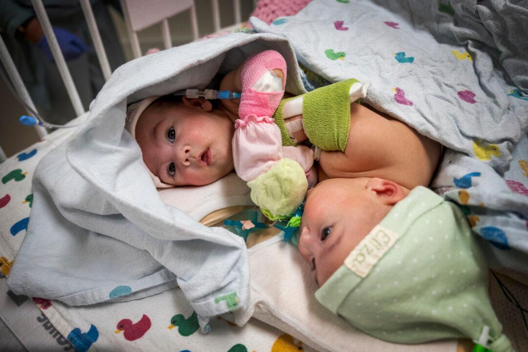 Formerly Conjoined Twins Welcomed Home 4 Weeks After Surgery