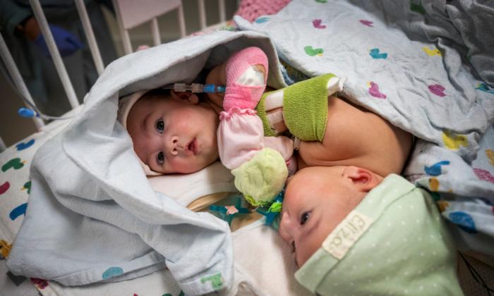 Formerly Conjoined Twins Welcomed Home 4 Weeks After Surgery
