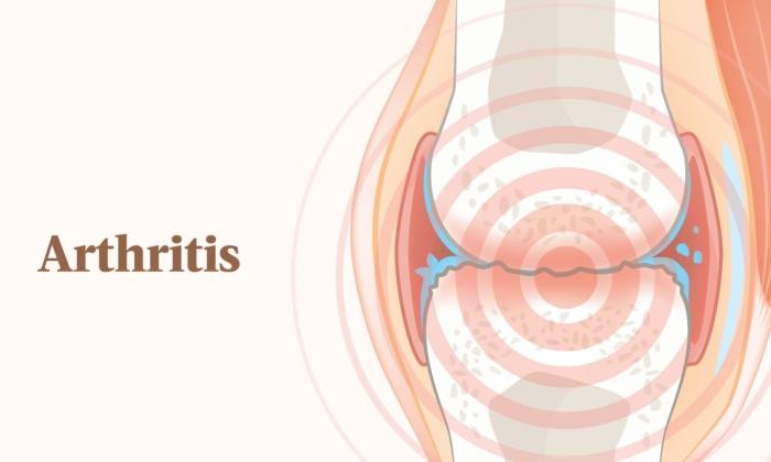 The Essential Guide to Arthritis: Symptoms, Causes, Treatments, and Natural Approaches