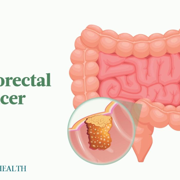 The Essential Guide to Colorectal Cancer: Symptoms, Causes, Treatments, and Natural Approaches