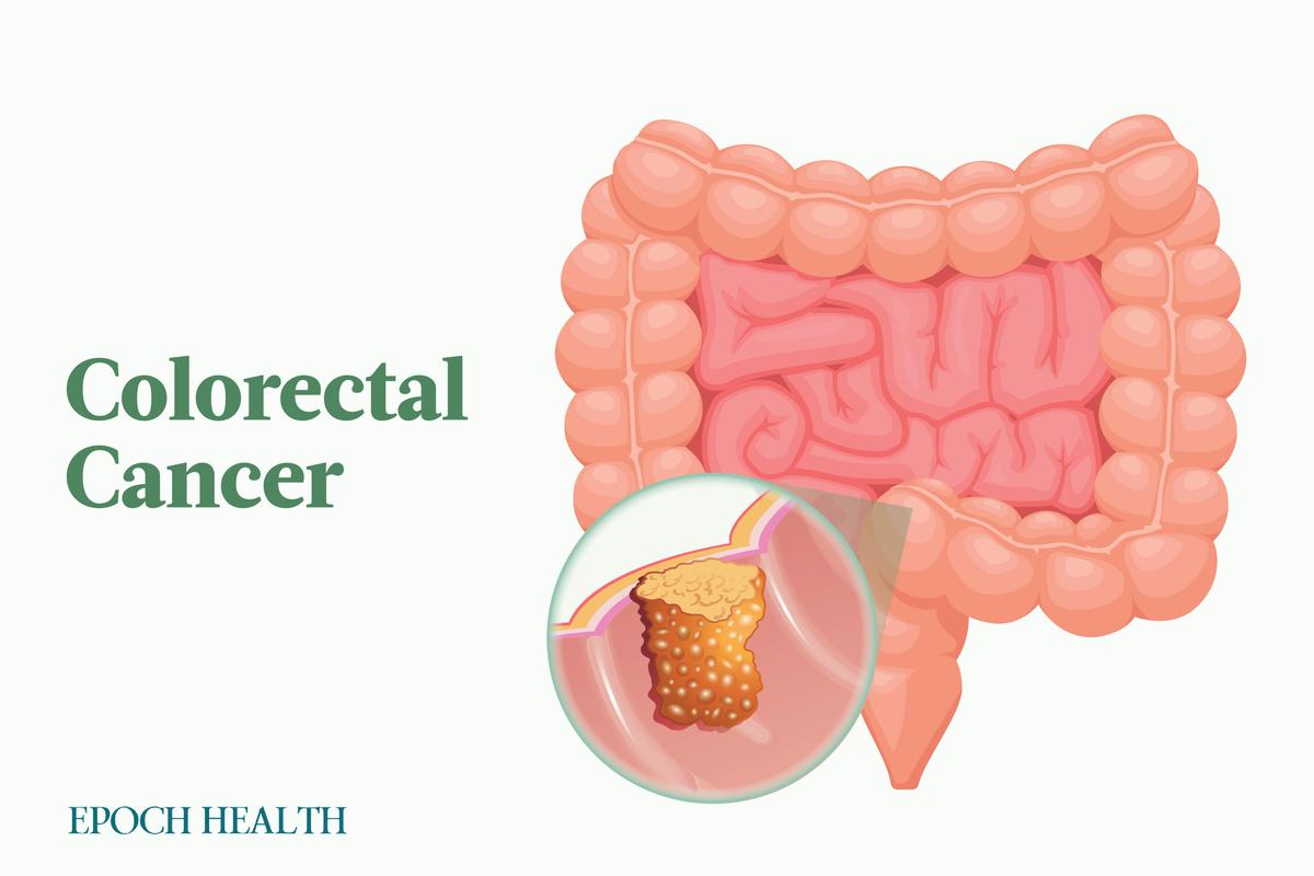 The Essential Guide to Colorectal Cancer: Symptoms, Causes, Treatments, and Natural Approaches