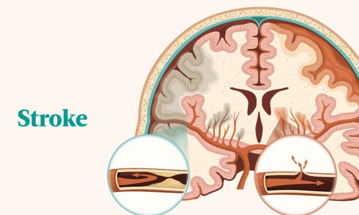The Essential Guide to Stroke: Symptoms, Causes, Treatments, and Natural Approaches
