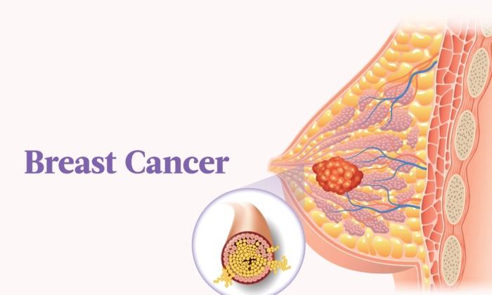 The Essential Guide to Breast Cancer: Symptoms, Causes, Treatments, and Natural Approaches