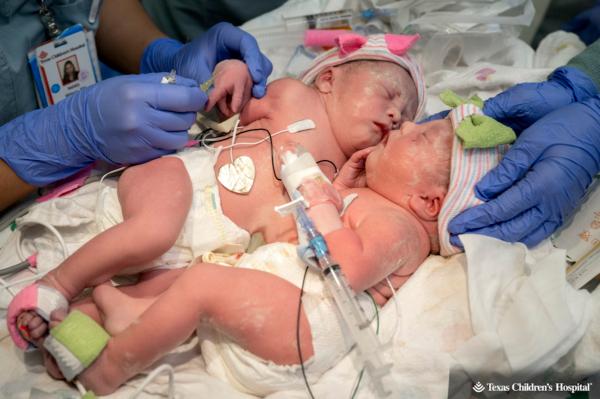 Conjoined twins Ella and Eliza Fuller were born via c-section at Texas Children's Pavilion for Women in Houston, Texas, on March 1, 2023. (Texas Children's Hospital)
