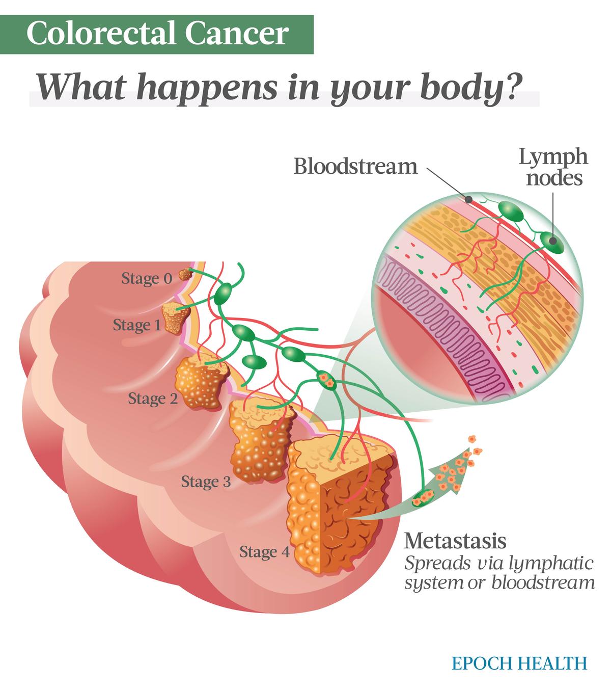 Colorectal cancer occurs when cancer cells divide uncontrollably in the colon or rectum, eventually developing into a tumor. (The Epoch Times)