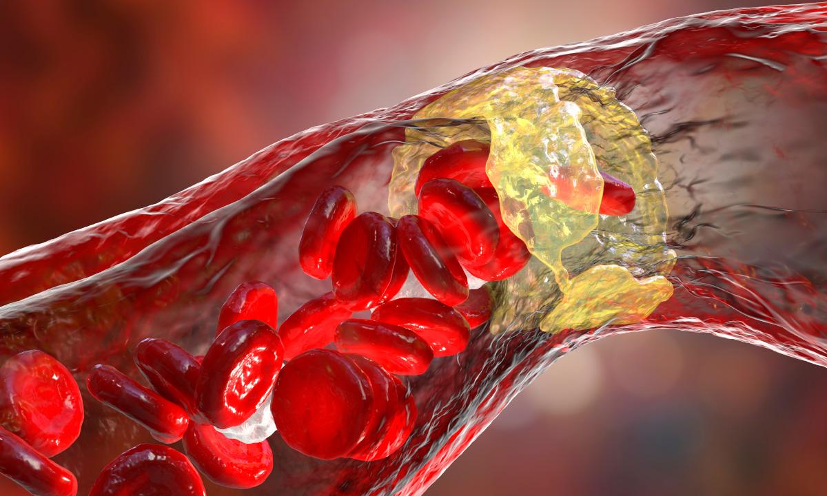 ‘Bad’ Cholesterol May Not Be So Bad