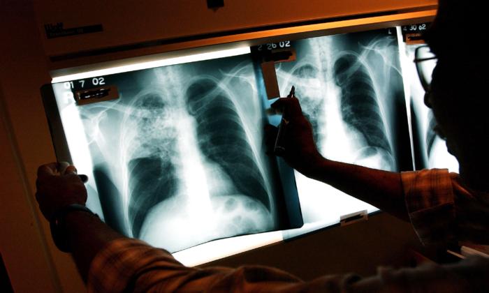 California Agency Issues ‘Health Advisory’ on Tuberculosis