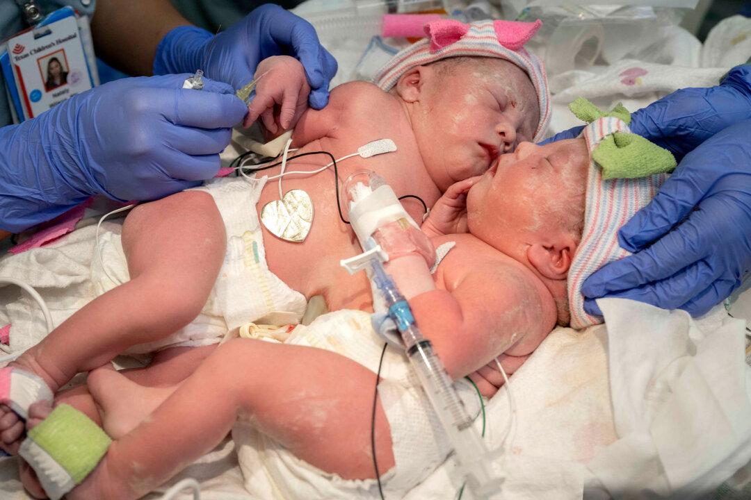 Happy Homecoming for Conjoined Twins After a Complex 6-Hour Separation Surgery