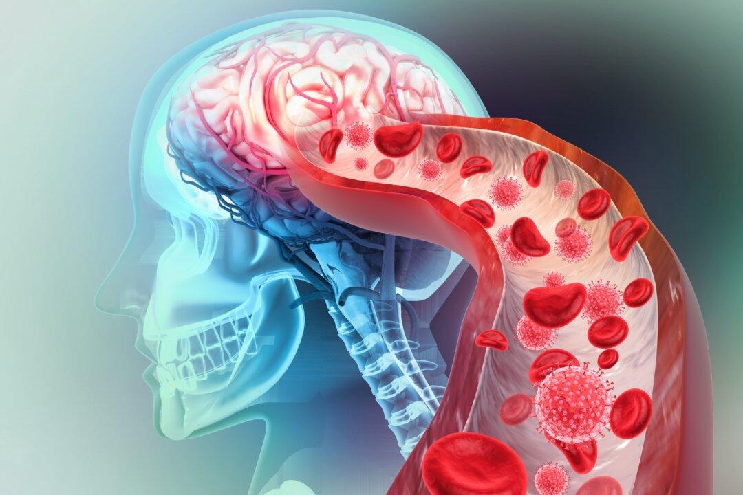 Risk of Stroke Skyrockets With COVID-19 Infection After Vaccination