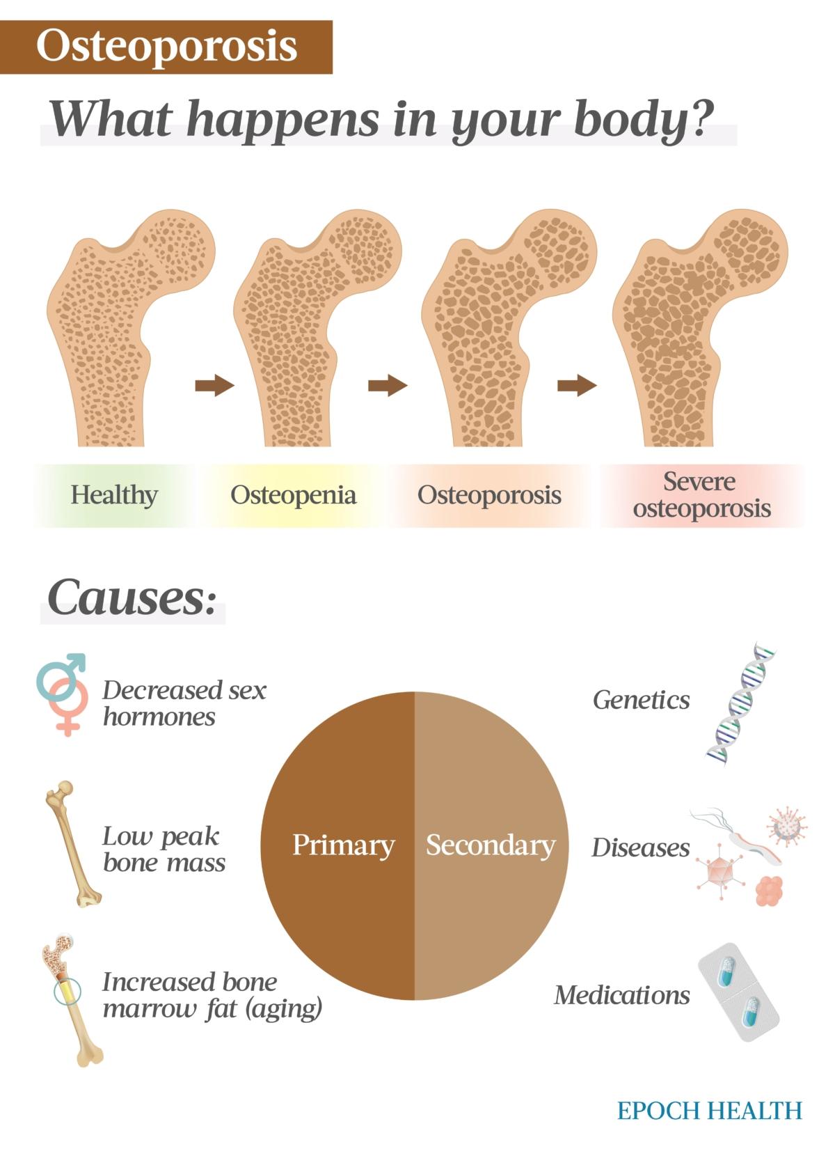 Osteoporosis can be caused by primary or secondary factors. (The Epoch Times)