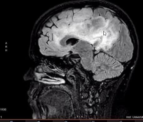 A recent scan of Mrs. Kann's brain. (Courtesy of <a href="https://www.facebook.com/profile.php?id=100093423486061">Tasha Kann</a>)