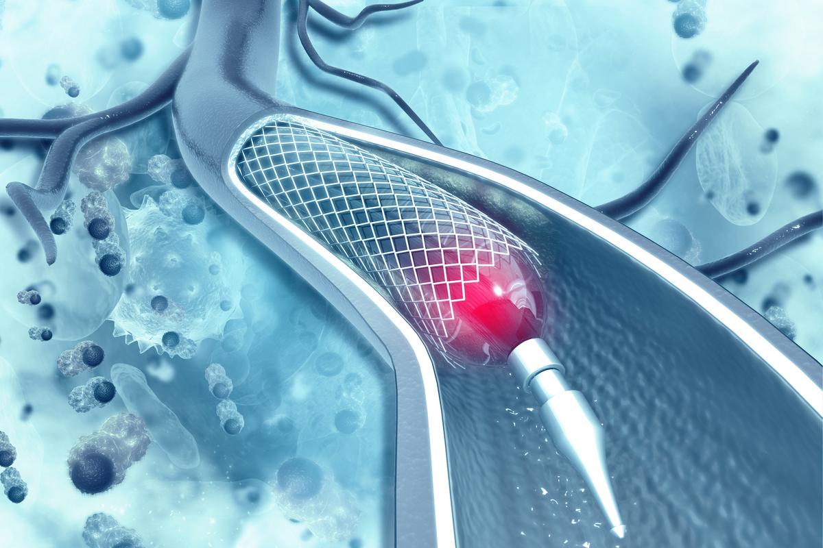 Angioplasty Heart Stent Risks Versus Benefits