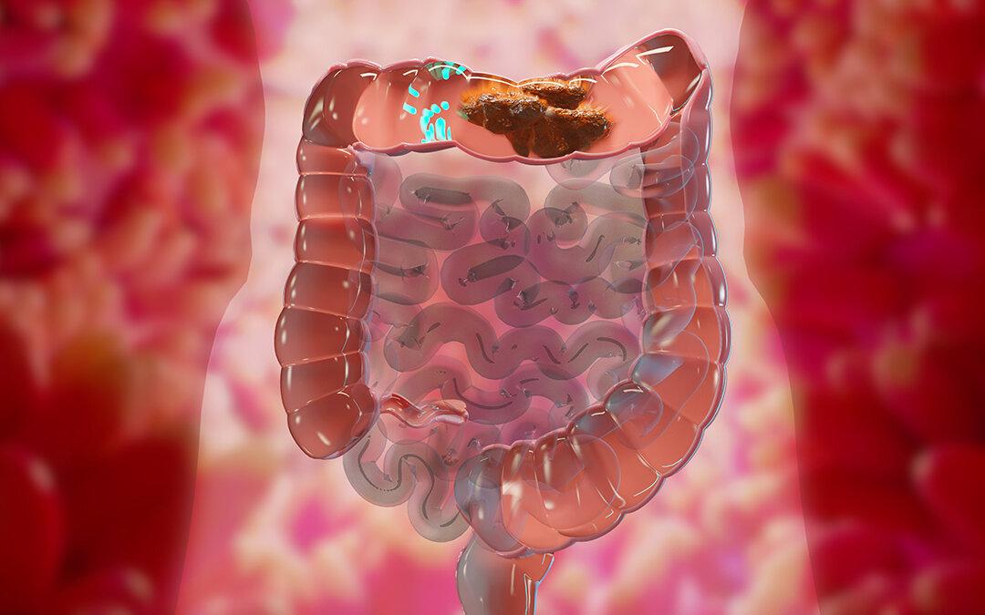 Study Links Constipation to Cognitive Decline