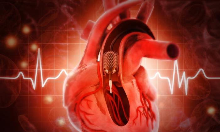 Do Heart Stent Procedures Work for Angina Chest Pain?