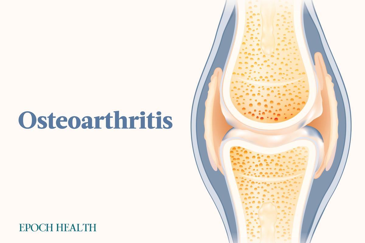Osteoarthritis: Symptoms, Causes, Treatments, and Natural Approaches
