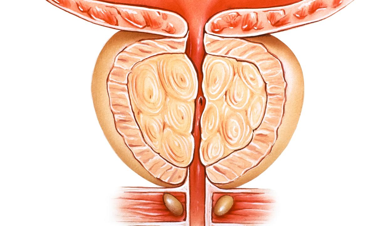 Manage Your Enlarged Prostate With These Tips