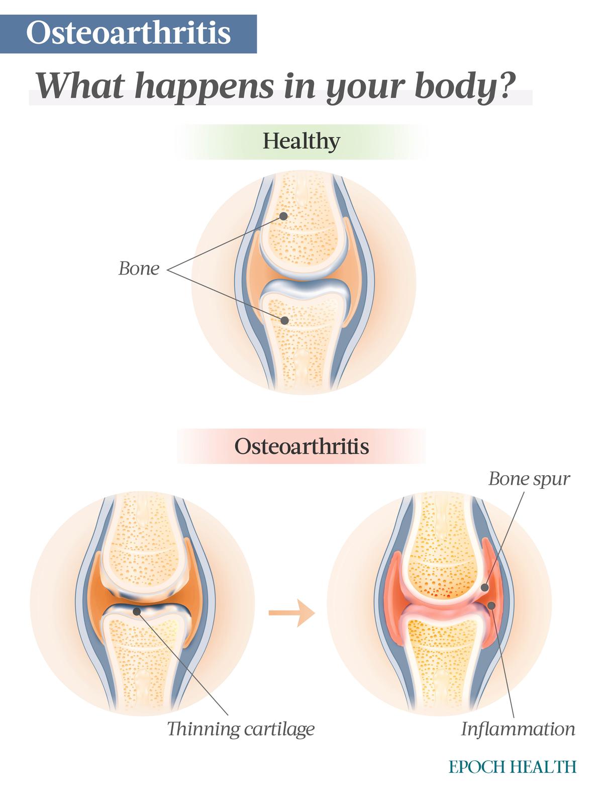 In primary osteoarthritis, an overproduction of enzymes triggers the deterioration of cartilage and inflammation, and eventually, bone spurs. (The Epoch Times)