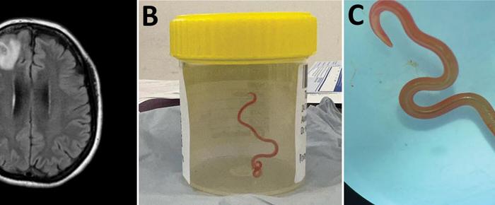 ‘Alive and Wriggling’: 8 Centimetre Worm Extracted From Woman’s Brain