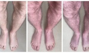 Purplish Discoloration of the Legs: An Unusual Long-COVID Symptom