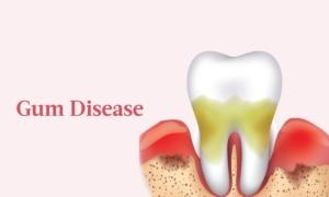 The Essential Guide to Gum Disease: Symptoms, Causes, Treatments, and Natural Approaches