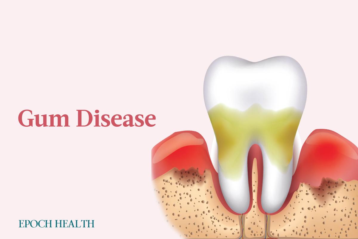 Gum Disease: Symptoms, Causes, Treatments, and Natural Approaches