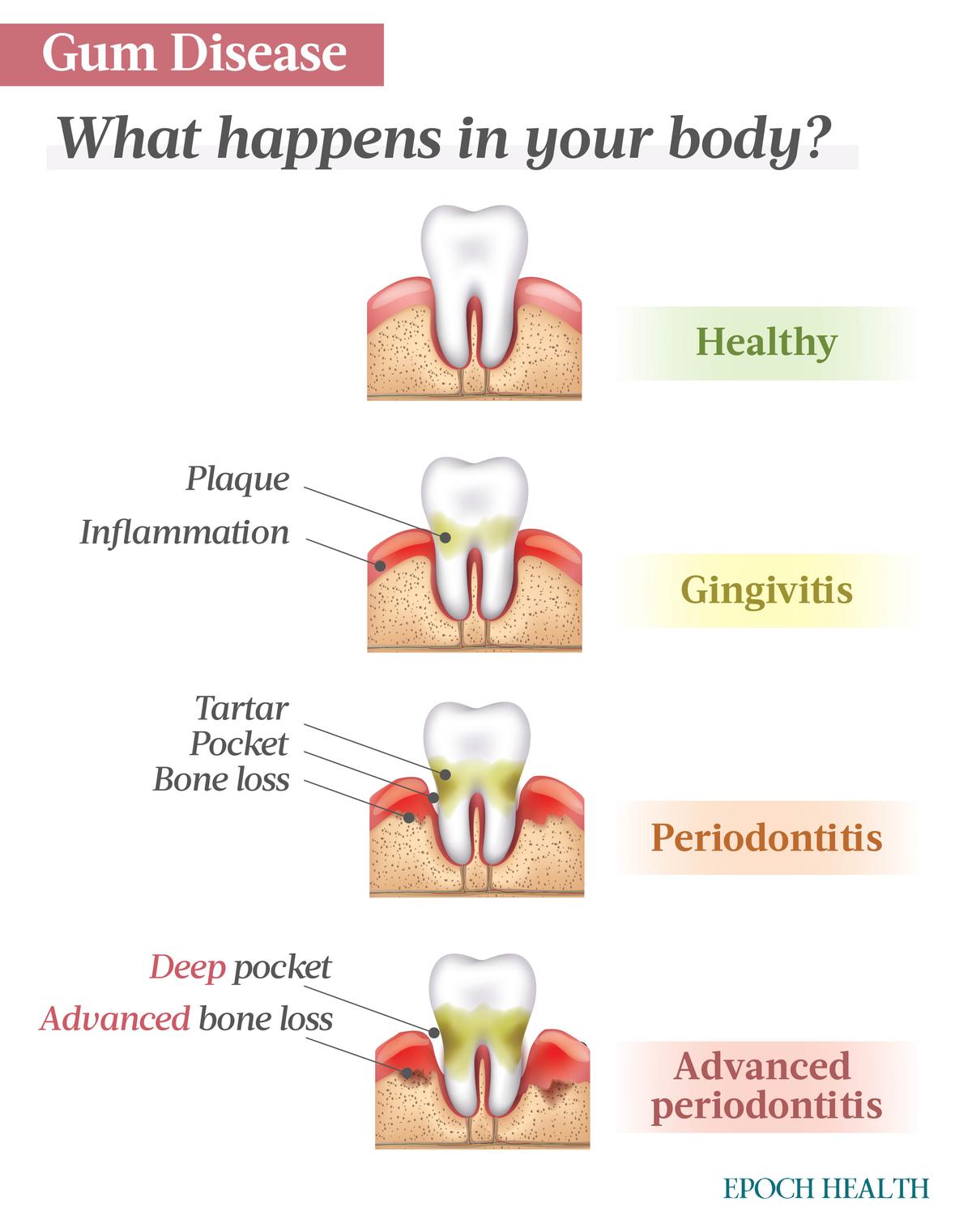 Bacteria overgrowth causes plaque, which can harden into tartar that leads to inflammation, pockets, and bone loss. (Illustrations from Shutterstock/Designed by The Epoch Times)