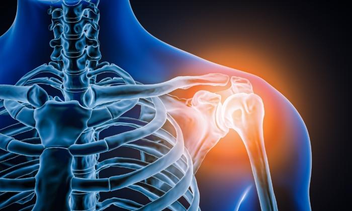 Frozen Shoulder: An Inflammatory Condition and 6 Top Exercises for Relief