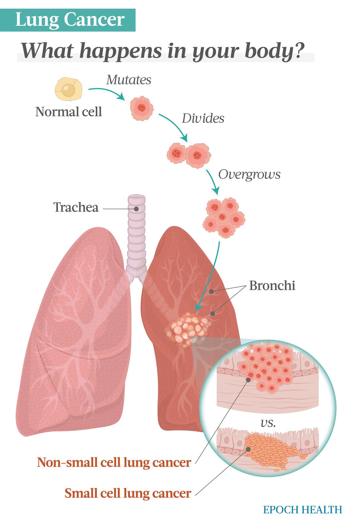 The difference between non-small cell lung cancer and small cell lung cancer has to do with the size of the cells. Additionally, SCLC is more aggressive. (Illustrations from Shutterstock/Designed by The Epoch Times)