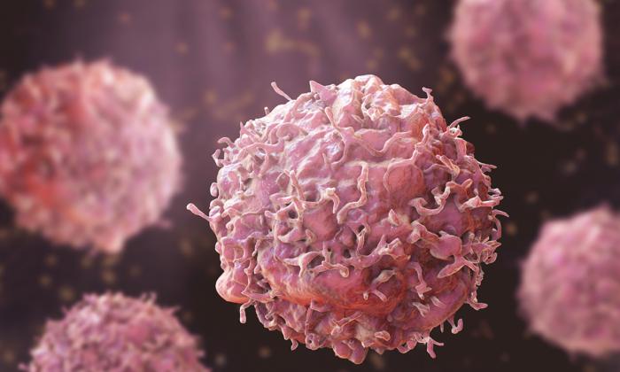 Study Finds Early-Onset Cancers Skyrocketing Globally: A Closer Look