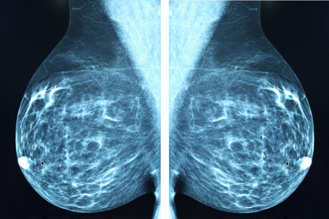 Is AI the Future of Breast Cancer Detection?
