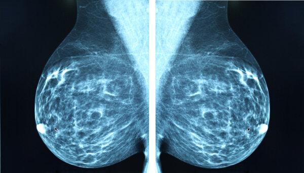 Is AI the Future of Breast Cancer Detection?