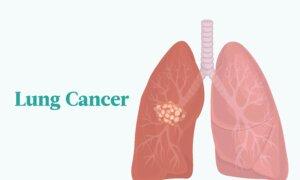 Lung Cancer: Symptoms, Causes, Treatments, and Natural Approaches