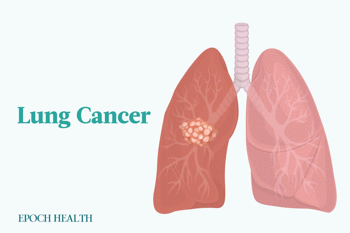 Lung Cancer: Symptoms, Causes, Treatments, and Natural Approaches