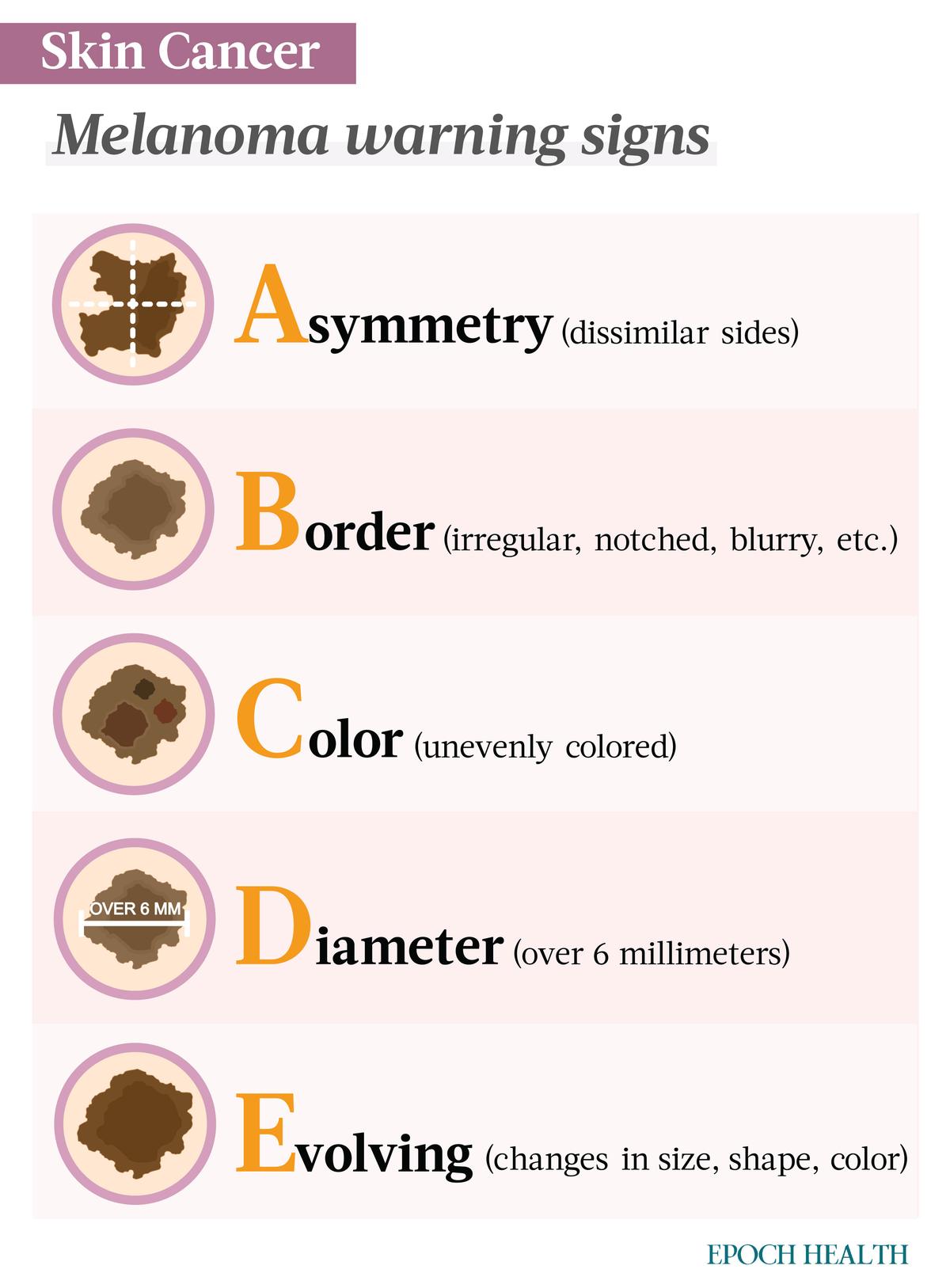 Watch for the ABCDE signs in moles on your body. (Illustrations from Shutterstock/Designed by The Epoch Times)