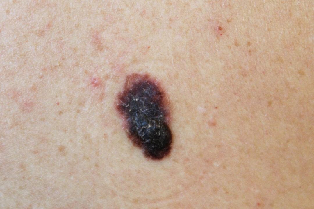 FDA Approves 1st T-Cell Therapy for Melanoma