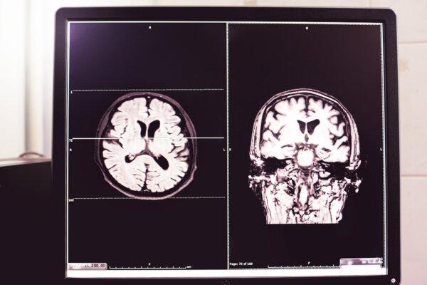  A brain scan of an atrophied brain. (Atthapon Raksthaput/Shutterstock)