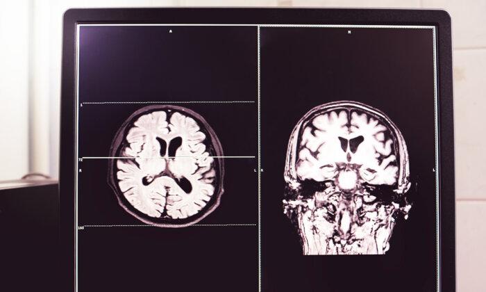 Stroke Deaths Expected to Rise 50 Percent by 2050, Says Study