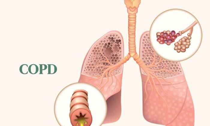 COPD: Symptoms, Causes, Treatments, and Natural Approaches