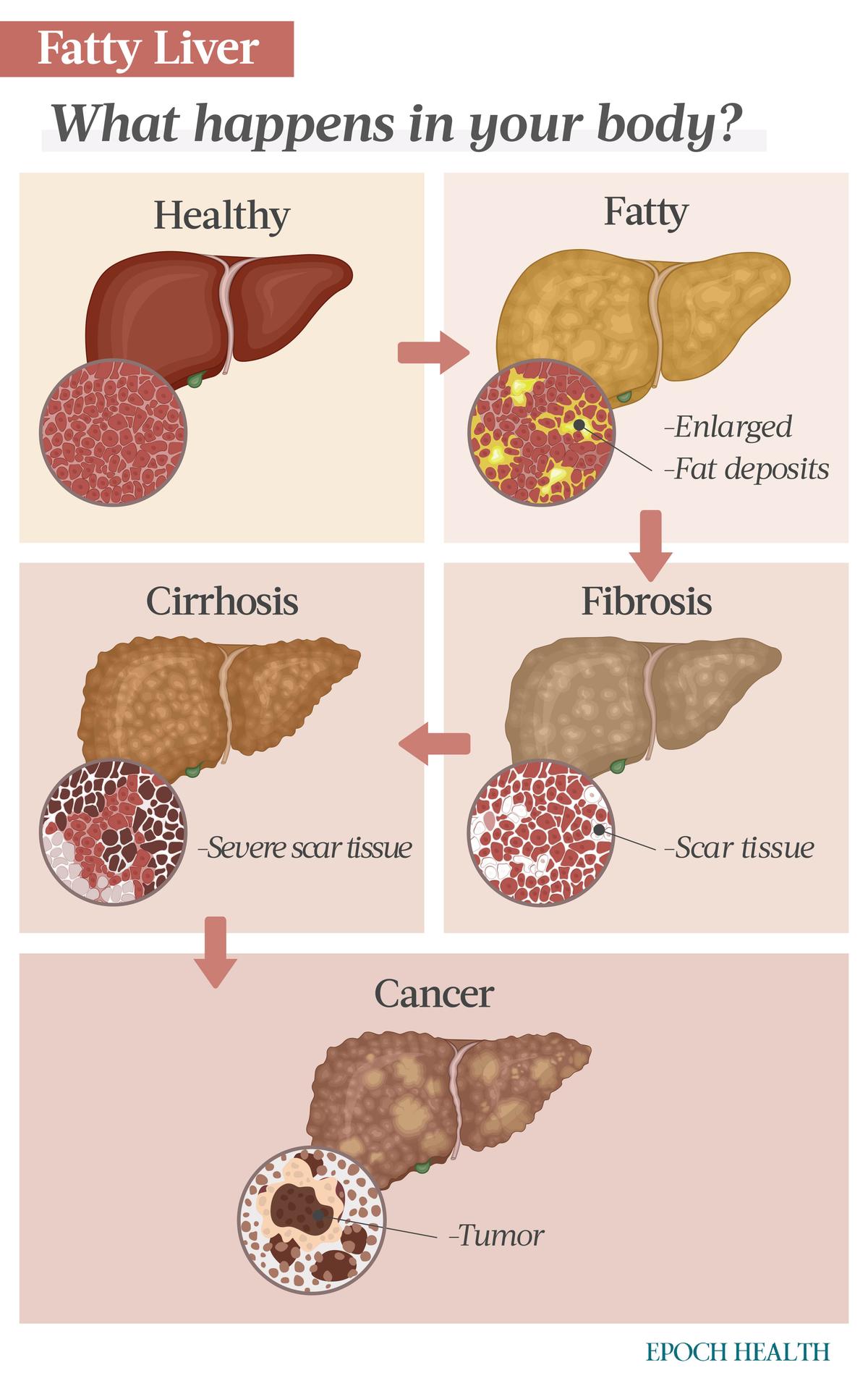 While fatty liver doesn’t require immediate medical attention, inflammation and scarring can occur if it advances. Fibrosis can develop into irreversible cirrhosis, which puts an individual at risk of liver failure and cancer. (Illustration by The Epoch Times, Shutterstock)