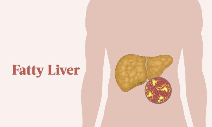 Fatty Liver: Symptoms, Causes, Treatments, and Natural Approaches