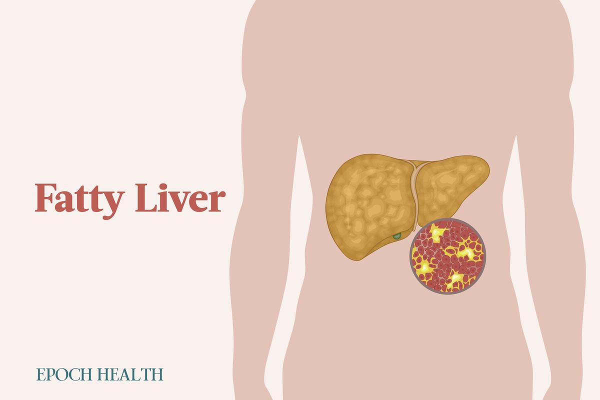 Fatty Liver: Symptoms, Causes, Treatments, and Natural Approaches
