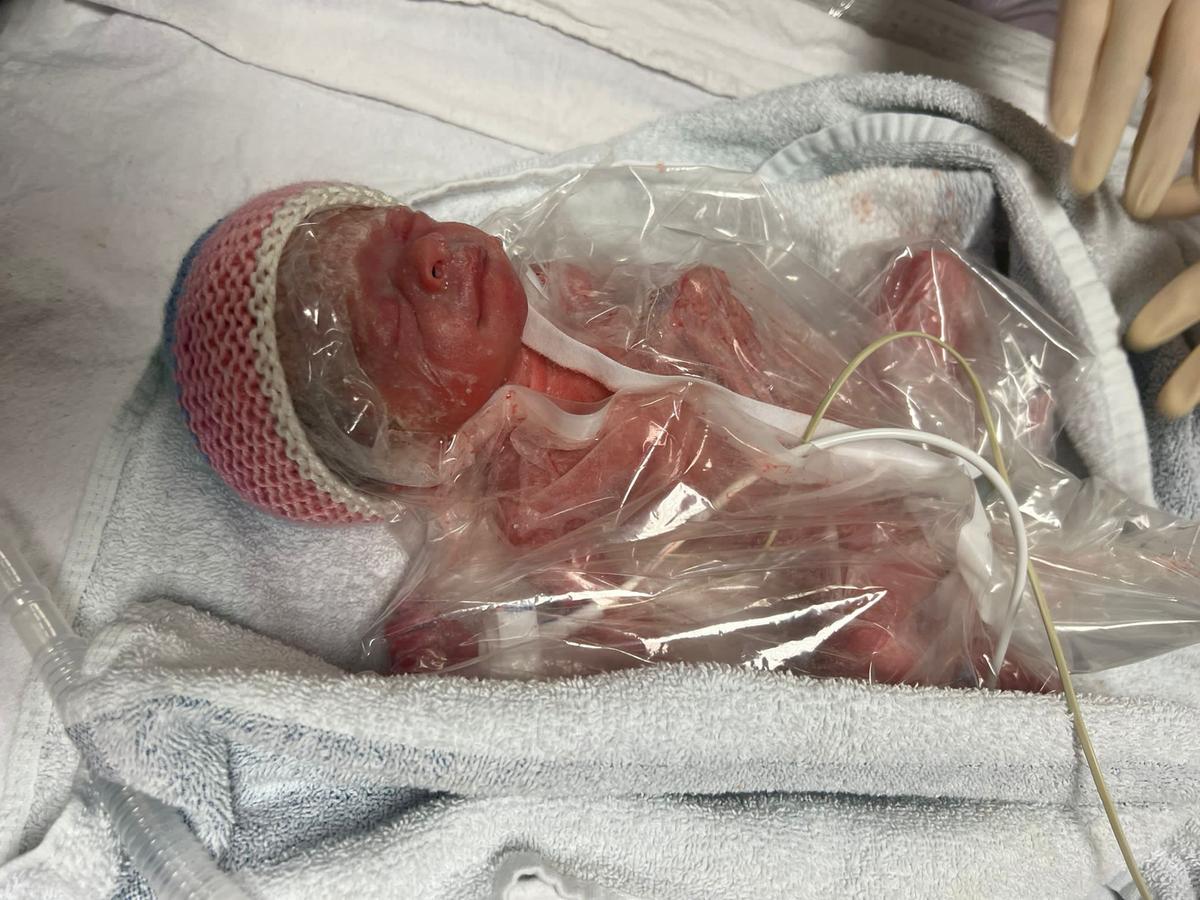 Premature baby Amelia in 2022. (SWNS)