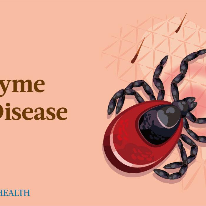 Lyme Disease: Symptoms, Causes, Treatments, and Natural Approaches