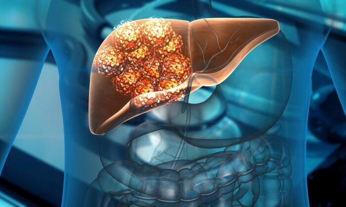 Liver Cancer: Diagnosis and Treatment for a ‘Silent’ Threat