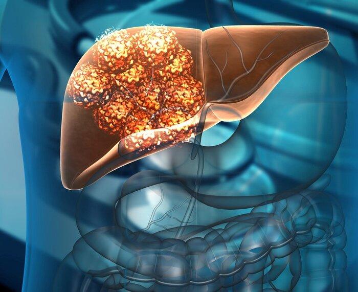 Liver Cancer: Diagnosis and Treatment for a ‘Silent’ Threat